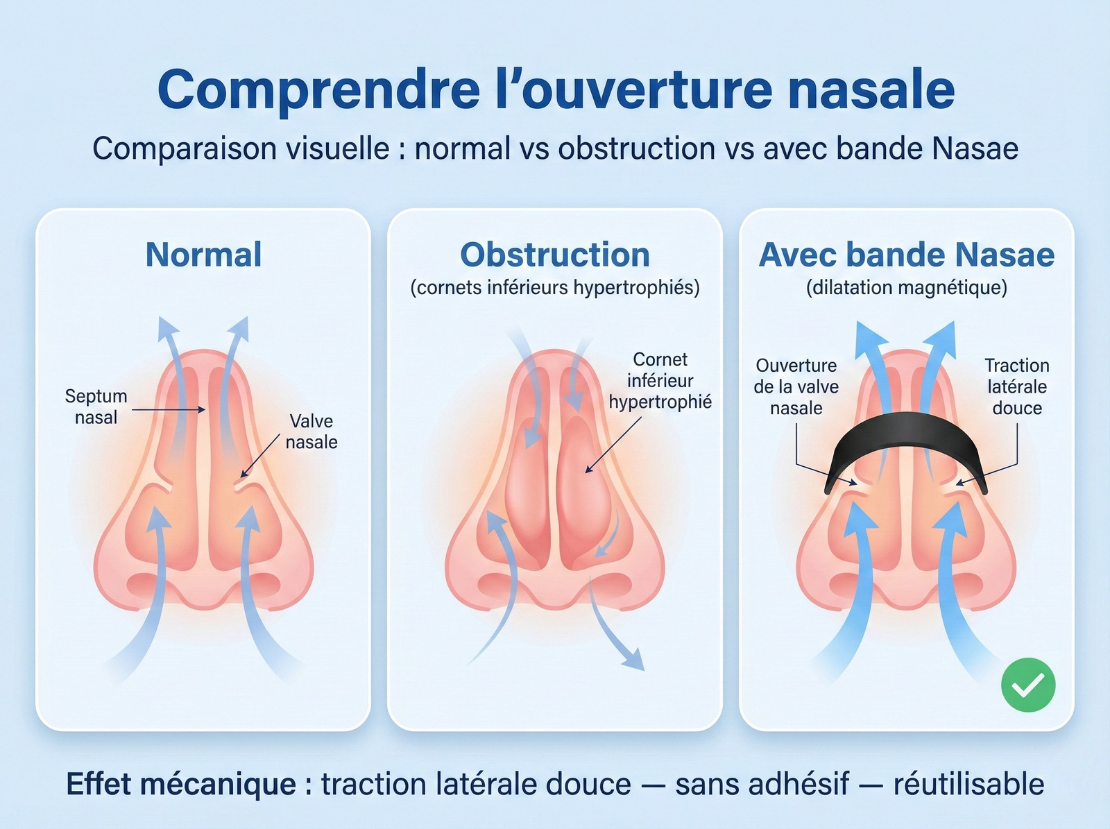 La dilatation nasale agit